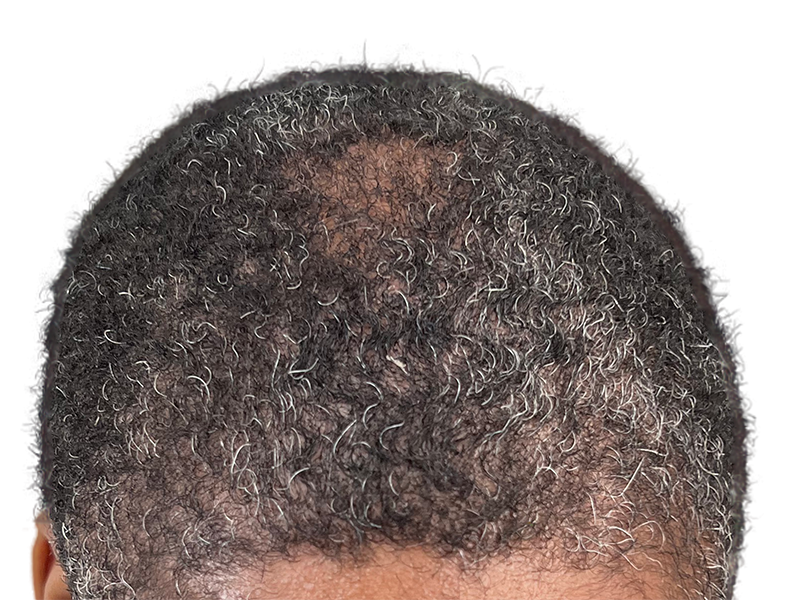 Thinning hair at crown. Potential hair transplant candidate. Before hair restoration treatment. Graying, curly hair.