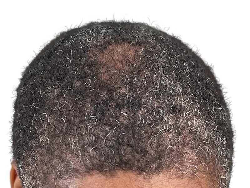 Thinning hair at crown. Potential hair transplant candidate. Before hair restoration treatment. Graying, curly hair.
