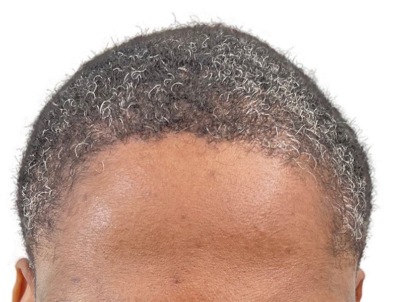 Natural hairline. Hair restoration result? Graying, curly hair. No visible transplant signs or scarring. Before/After potential.