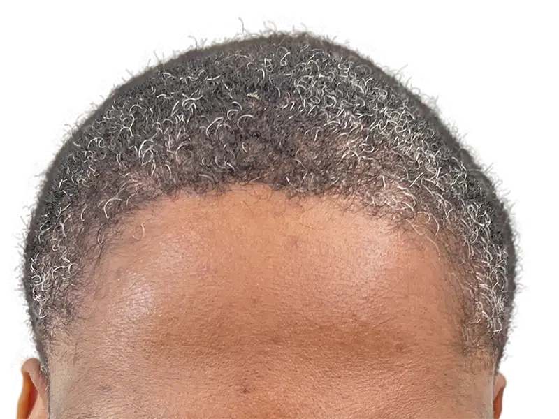Natural hairline. Hair restoration result? Graying, curly hair. No visible transplant signs or scarring. Before/After potential.