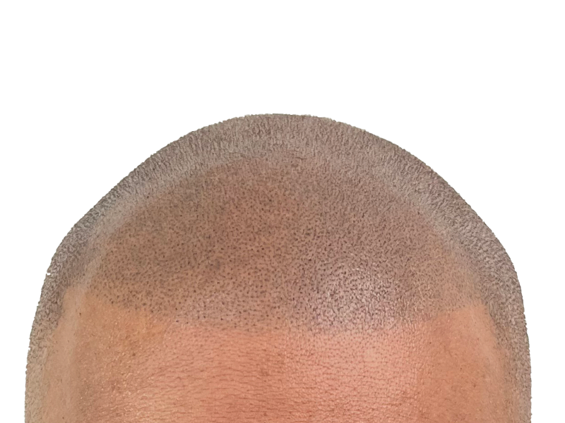 Hair transplant before & after: Caucasian man with restored hairline. Noticeable hair density improvement. Hair restoration results.