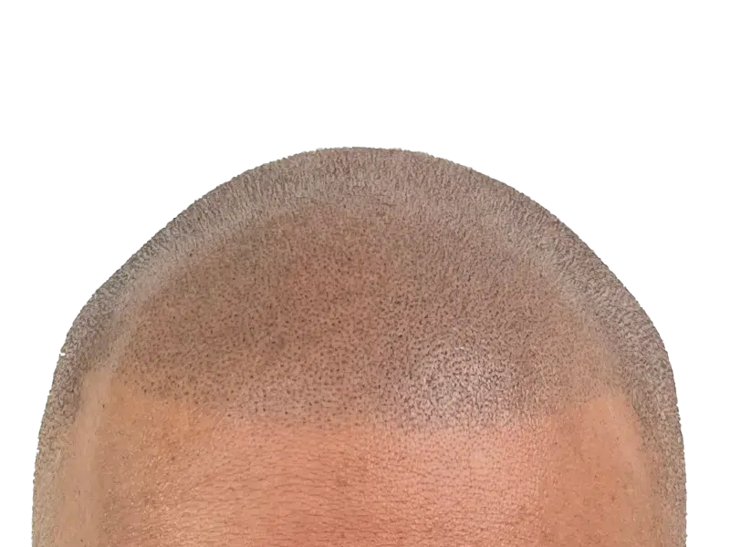 Hair transplant before & after: Caucasian man with restored hairline. Noticeable hair density improvement. Hair restoration results.