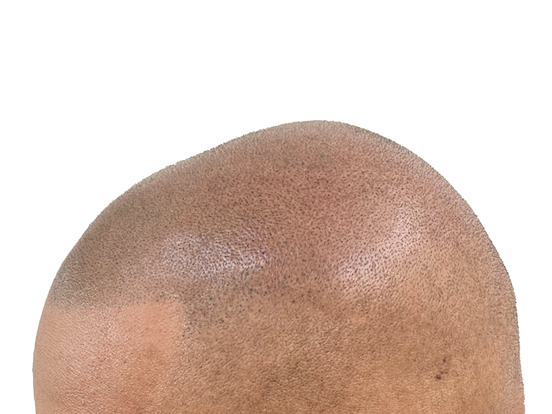 Hair transplant result: Dense, cropped hair on a Black or Hispanic man's scalp. Hair restoration success after hair loss.