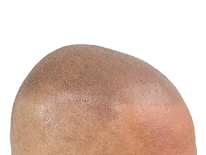 Hair transplant close-up: Light brown skin, visible grafts creating a shaved head look. Hair restoration procedure.