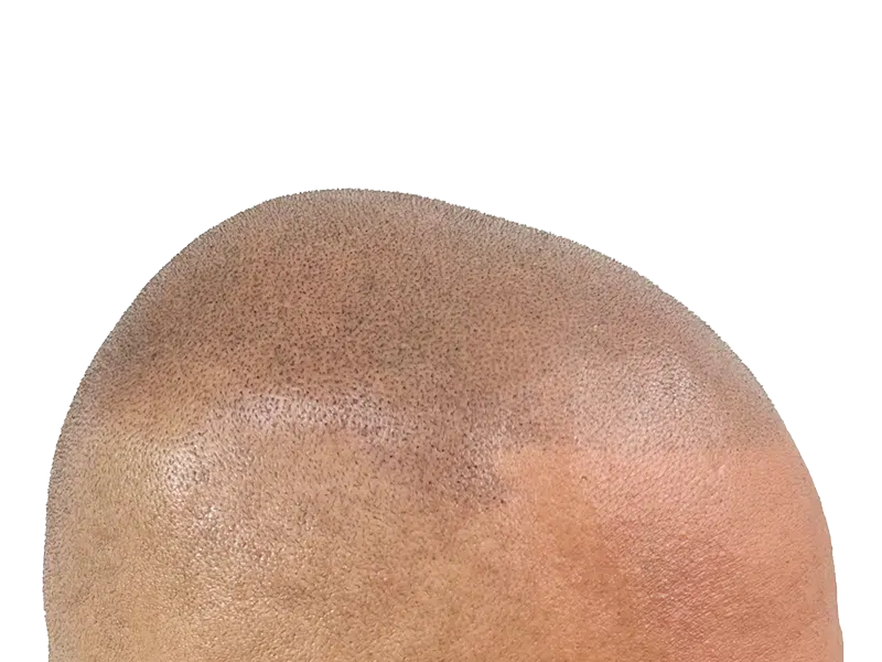 Hair transplant close-up: Light brown skin, visible grafts creating a shaved head look. Hair restoration procedure.