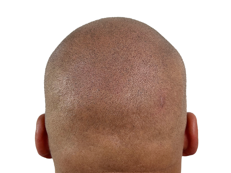 Hair transplant result: Restored hairline on person with closely cropped hair. Before/after hair restoration example.