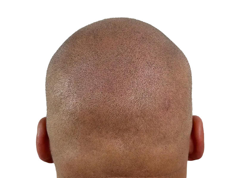 Hair transplant result: Restored hairline on person with closely cropped hair. Before/after hair restoration example.