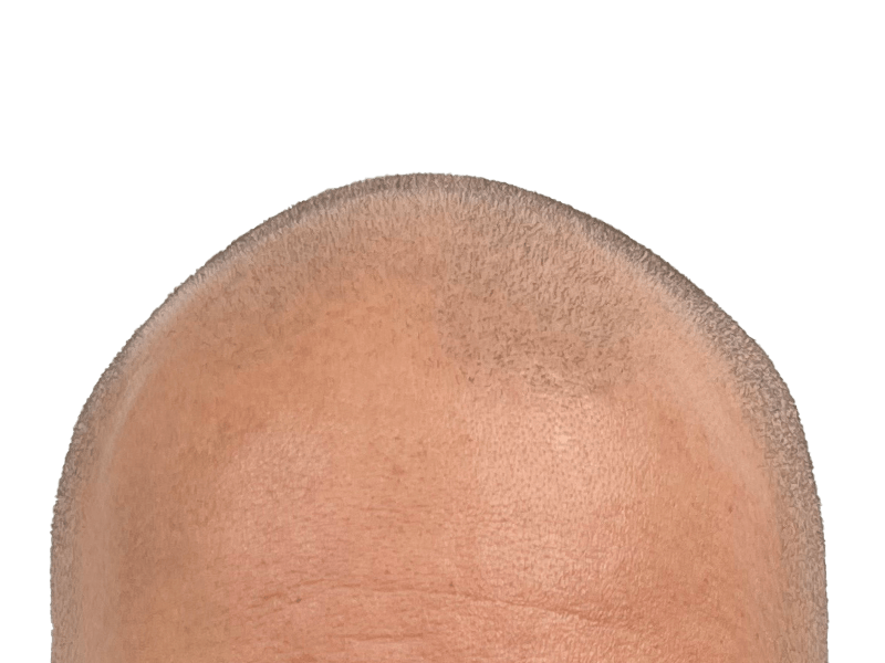 Close-up of shaved head. Possible hair transplant site. Examining hair follicles for restoration results.