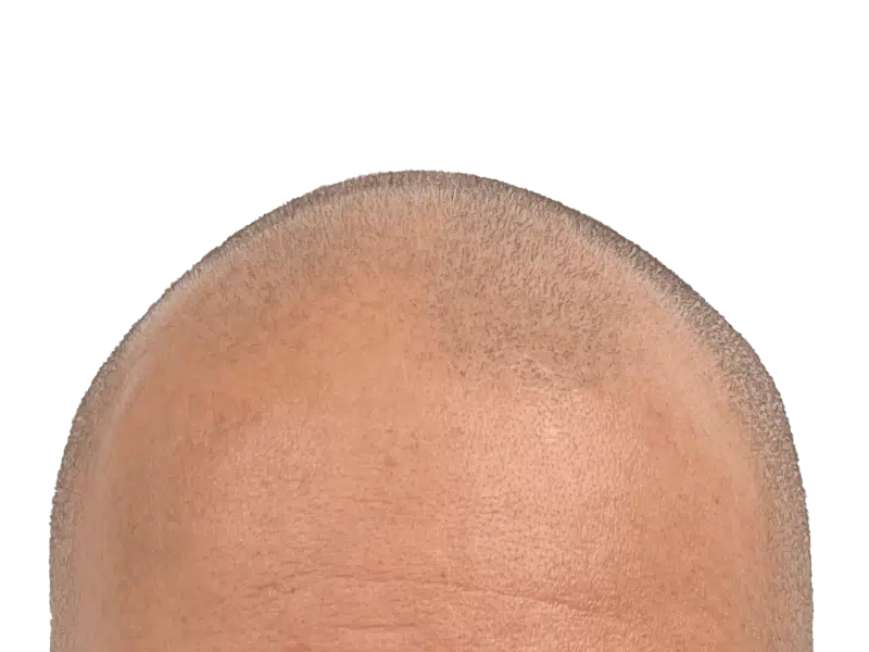 Close-up of shaved head. Possible hair transplant site. Examining hair follicles for restoration results.