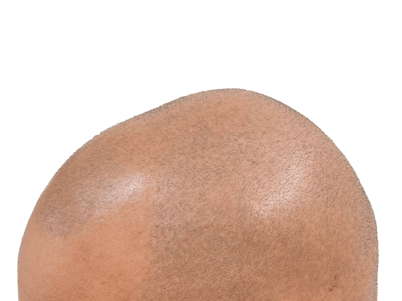 Close-up of shaved head. Light brown hair visible. Scalp detail for hair restoration or transplant evaluation.