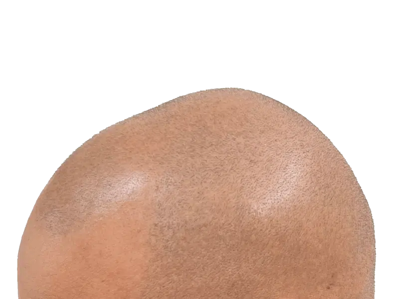 Close-up of shaved head. Light brown hair visible. Scalp detail for hair restoration or transplant evaluation.