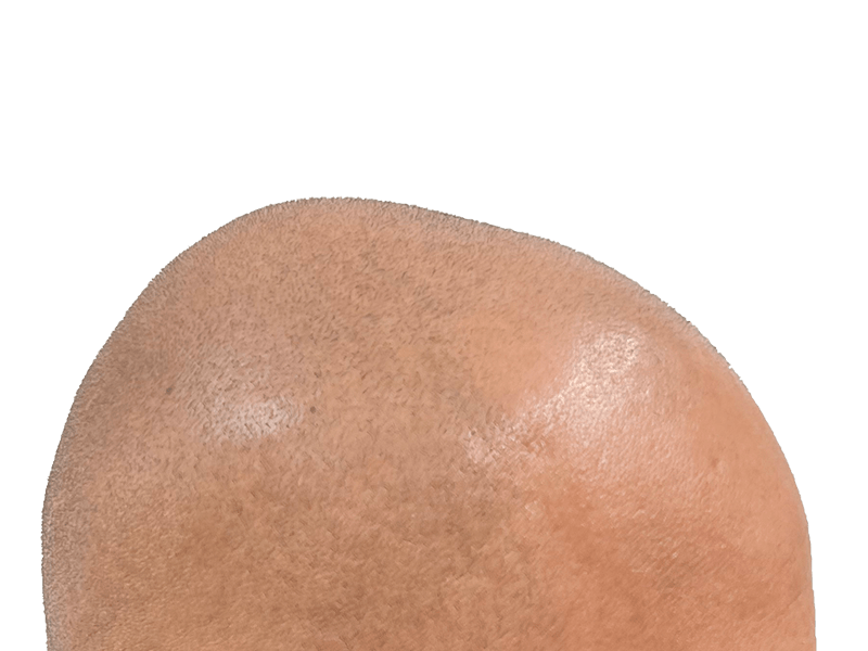 Close-up of shaved scalp. Hair restoration candidate. Before hair transplant procedure. Light brown skin tone.