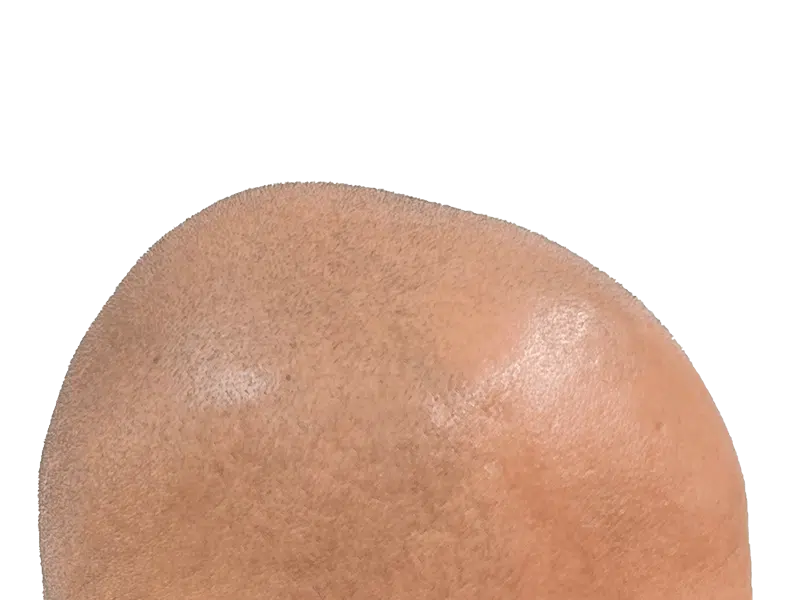 Close-up of shaved scalp. Hair restoration candidate. Before hair transplant procedure. Light brown skin tone.