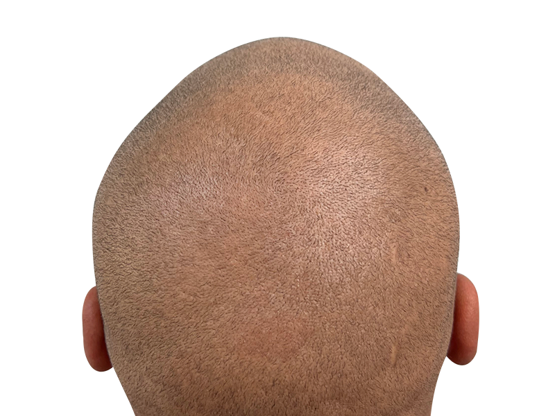Close-up of scalp showing short hair. Potential hair transplant result or natural hair pattern. Hair restoration possibility.