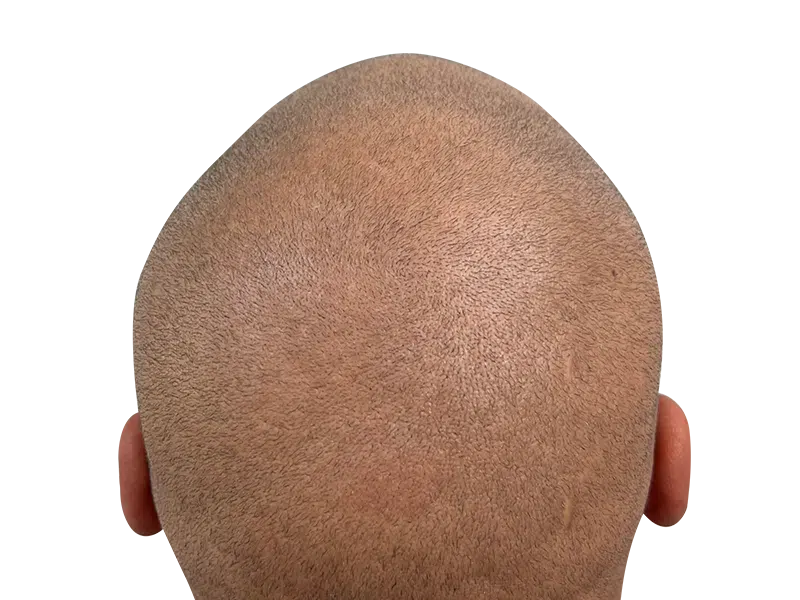 Close-up of scalp showing short hair. Potential hair transplant result or natural hair pattern. Hair restoration possibility.