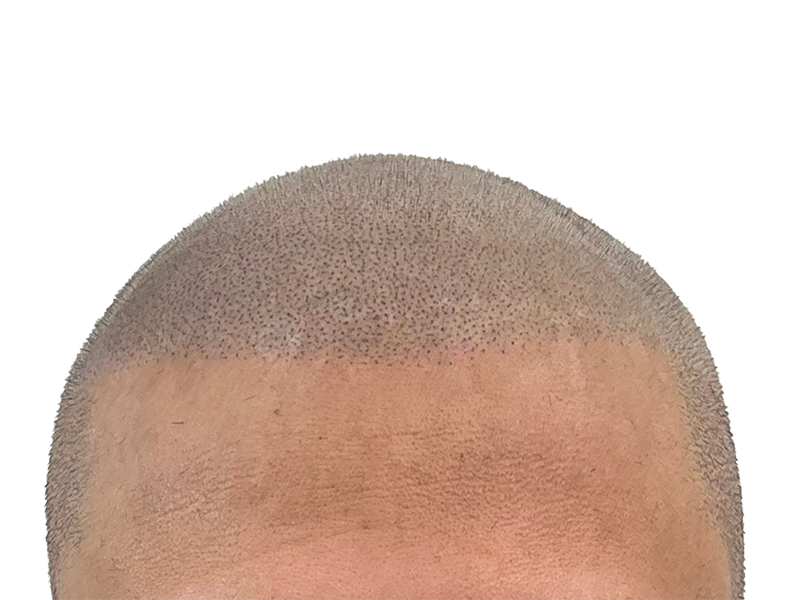 Hair transplant result: Restored hairline with even density. Buzz cut style shows successful hair restoration procedure.