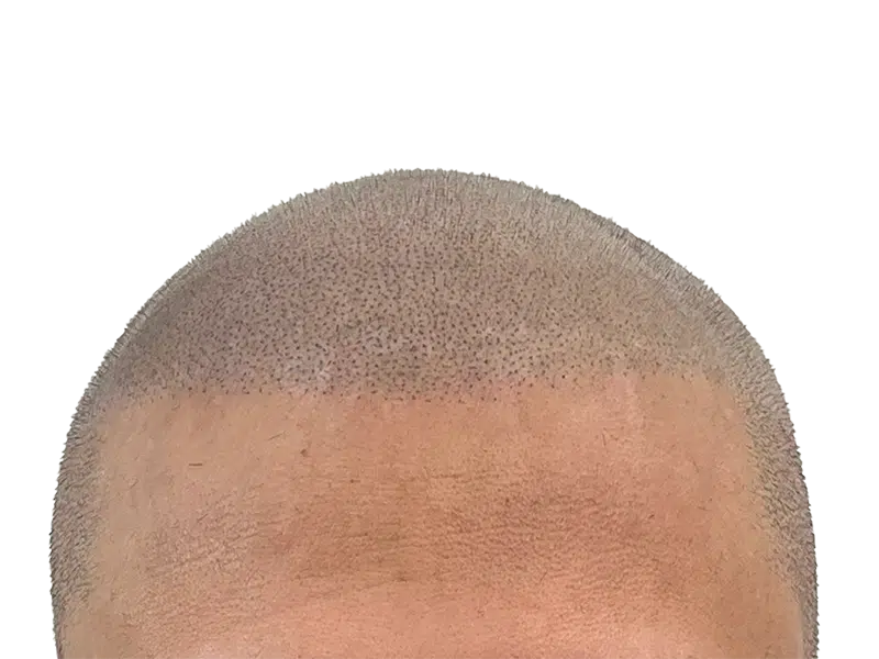 Hair transplant result: Restored hairline with even density. Buzz cut style shows successful hair restoration procedure.