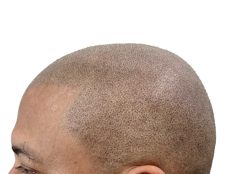Scalp micropigmentation (SMP) close-up. Hair restoration treatment for thinning hair. Simulated hair follicles on scalp.