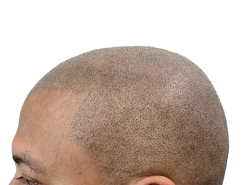 Scalp micropigmentation (SMP) close-up. Hair restoration treatment for thinning hair. Simulated hair follicles on scalp.
