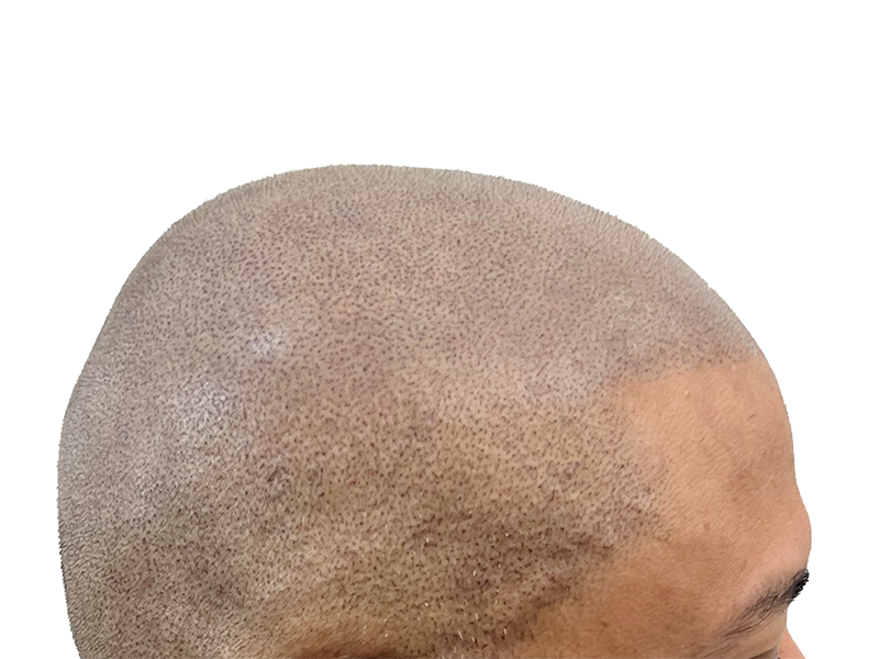 Hair transplant close-up: Dotted scalp shows new follicle implants. Before/after hair restoration results. Shaved head illusion.