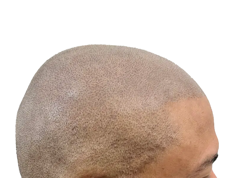 Hair transplant close-up: Dotted scalp shows new follicle implants. Before/after hair restoration results. Shaved head illusion.