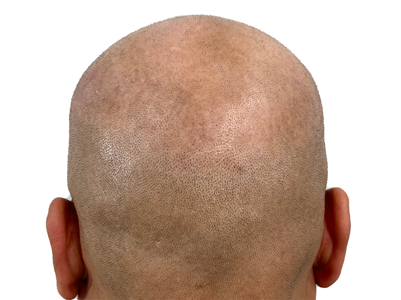 Hair transplant result: Close-up of scalp showing evenly distributed hair follicles. Natural-looking hair restoration.