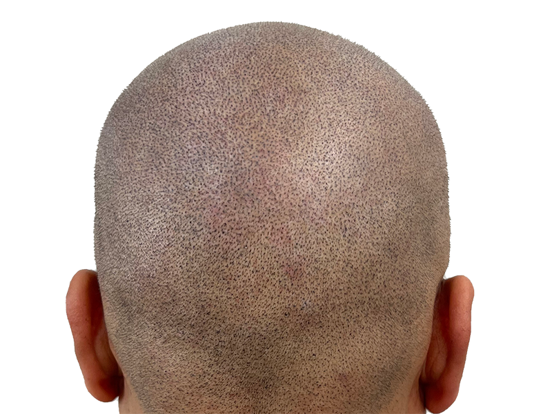 SMP hair restoration: Close-up of shaved head showing replicated hair follicles. Scalp Micropigmentation results for natural-looking hair density.