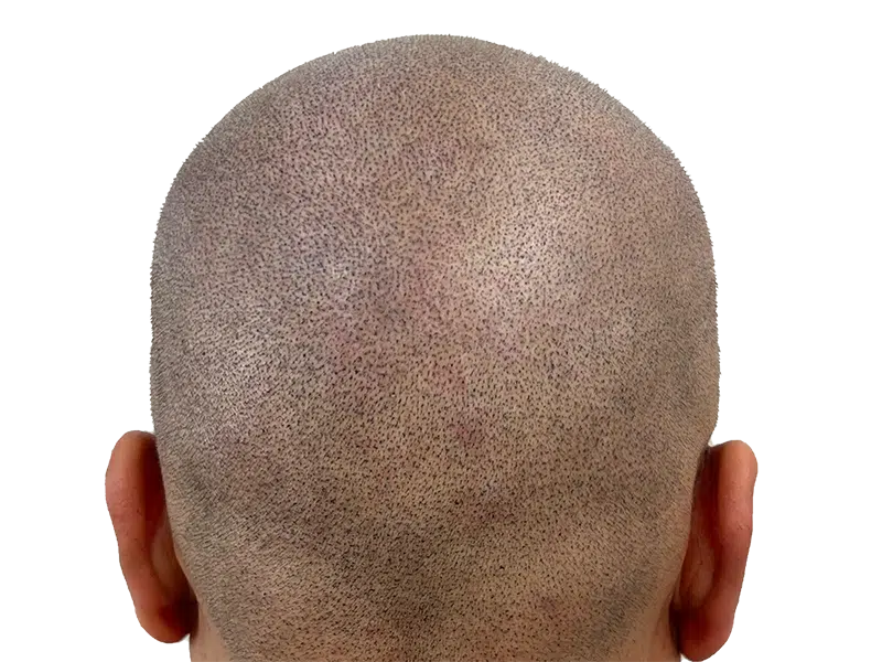 SMP hair restoration: Close-up of shaved head showing replicated hair follicles. Scalp Micropigmentation results for natural-looking hair density.