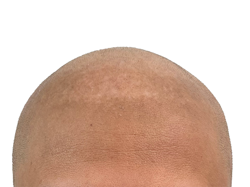 Hair transplant result: Close-up of scalp showing new hair growth after restoration procedure. Density visible.