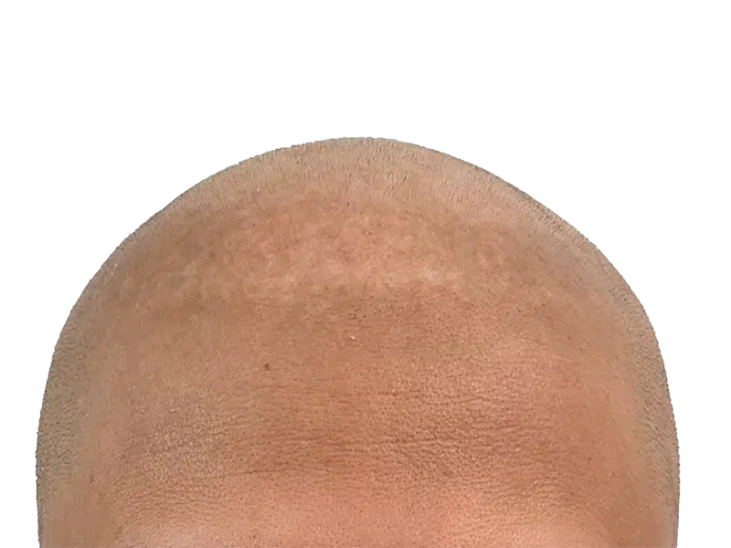Hair transplant result: Close-up of scalp showing new hair growth after restoration procedure. Density visible.