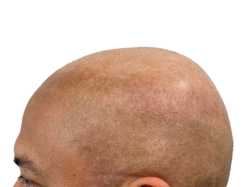 Hair transplant result: Shaved head showing transplanted follicles. Hair restoration procedure creating a uniform, natural look.