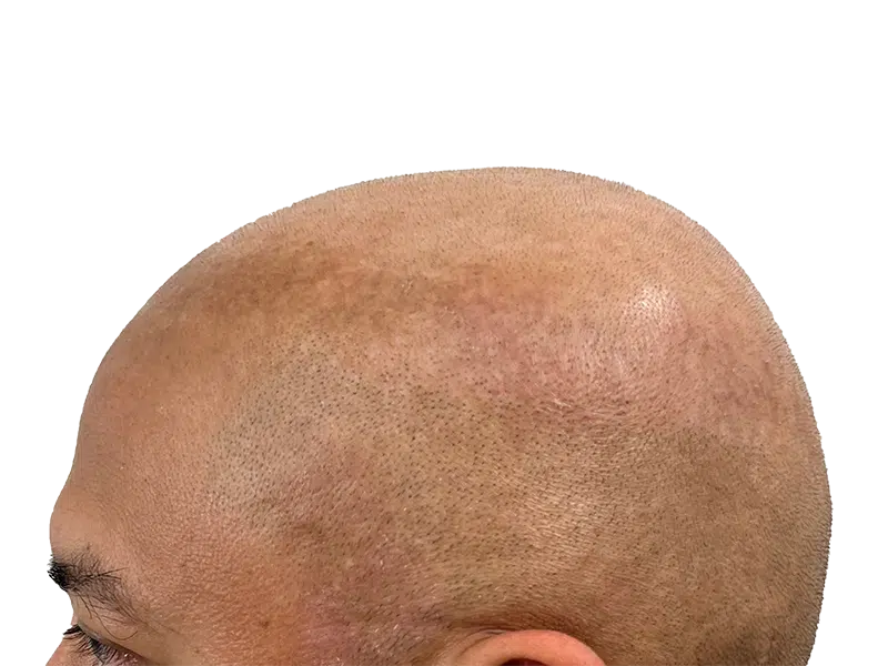 Hair transplant result: Shaved head showing transplanted follicles. Hair restoration procedure creating a uniform, natural look.