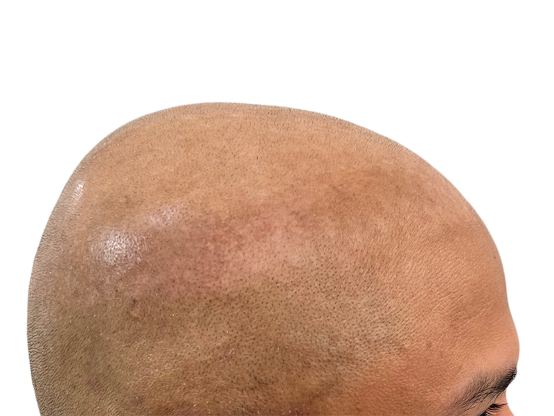 Hair transplant result: Shaved head showing new hair follicle growth. Hair restoration procedure success.