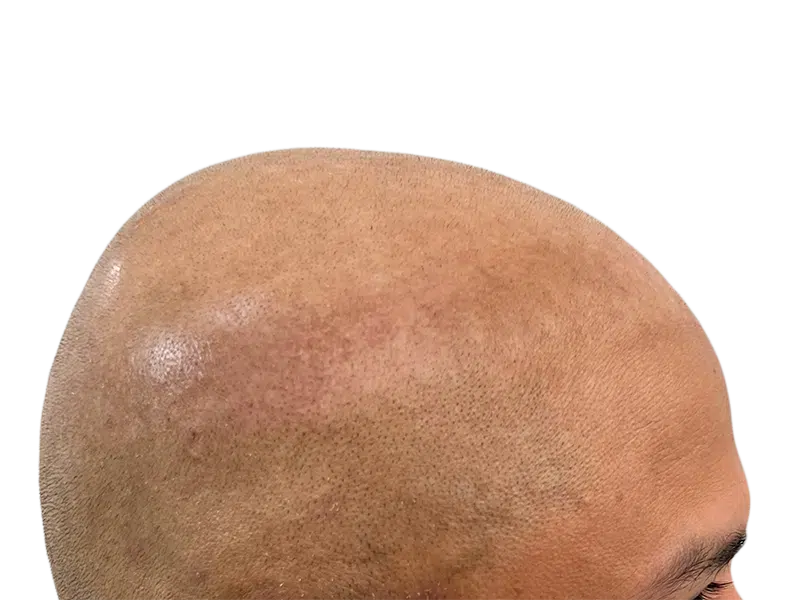 Hair transplant result: Shaved head showing new hair follicle growth. Hair restoration procedure success.