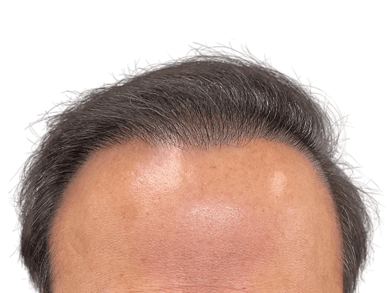 Hair transplant result: Natural, dense hairline restoration on a Caucasian man with graying hair. Forehead view.