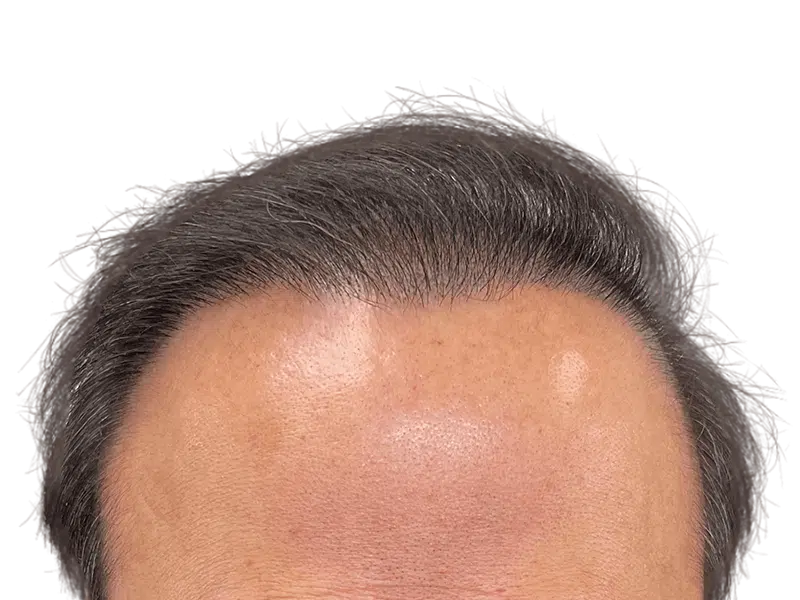 Hair transplant result: Natural, dense hairline restoration on a Caucasian man with graying hair. Forehead view.