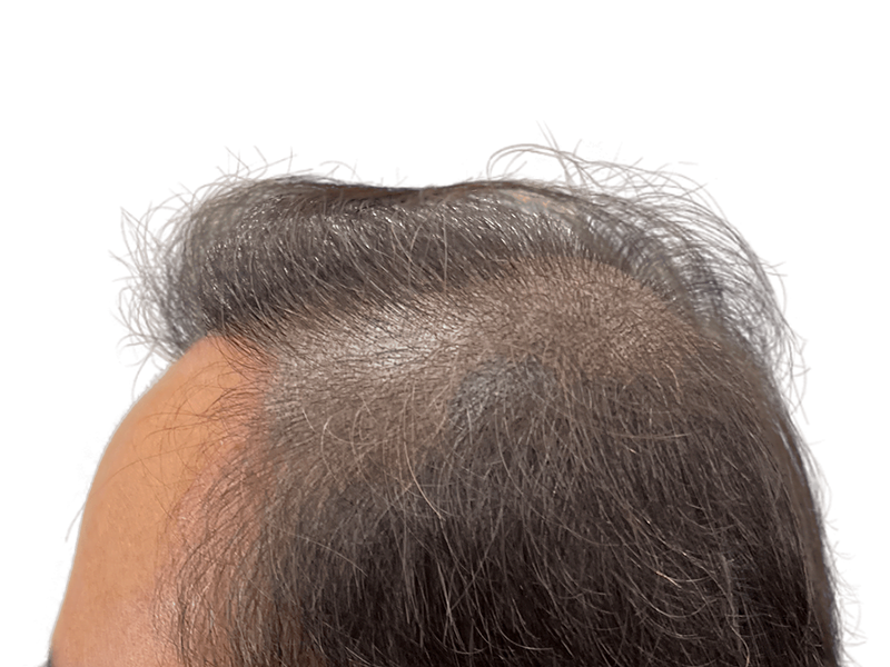Thinning hair & receding hairline. Consider hair restoration options for fuller hair. Before/after results may vary.