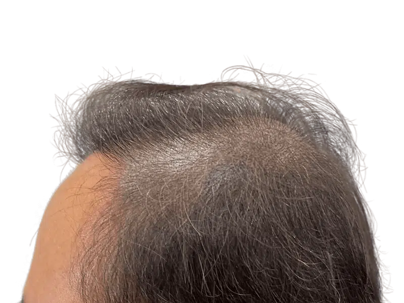 Thinning hair & receding hairline. Consider hair restoration options for fuller hair. Before/after results may vary.