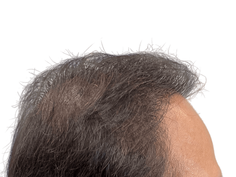 Thinning gray hair, receding hairline. Potential hair loss candidate. Consider hair restoration options.