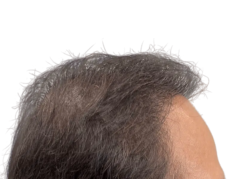 Thinning gray hair, receding hairline. Potential hair loss candidate. Consider hair restoration options.