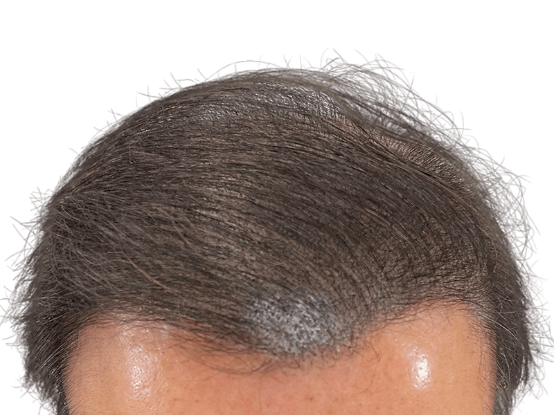Thinning hairline, possibly before hair restoration. Consider hair transplant options for fuller hair. Before/after results may vary.