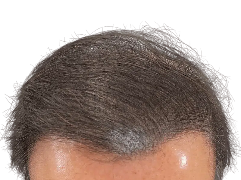 Thinning hairline, possibly before hair restoration. Consider hair transplant options for fuller hair. Before/after results may vary.