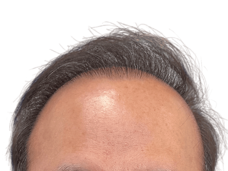 Receding hairline. Potential hair loss candidate. Consider hair restoration or transplant options for fuller hair.