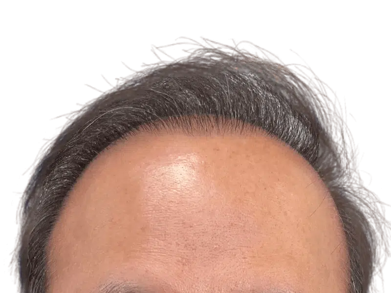 Receding hairline. Potential hair loss candidate. Consider hair restoration or transplant options for fuller hair.