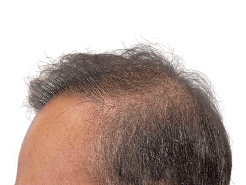 Thinning hair & receding hairline. Consider hair restoration options like hair transplants for fuller hair.