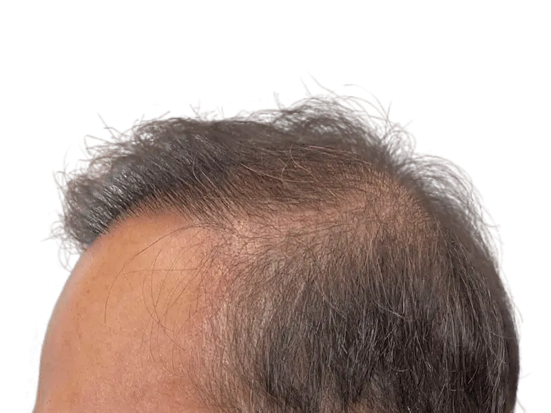 Thinning hair & receding hairline. Consider hair restoration options like hair transplants for fuller hair.