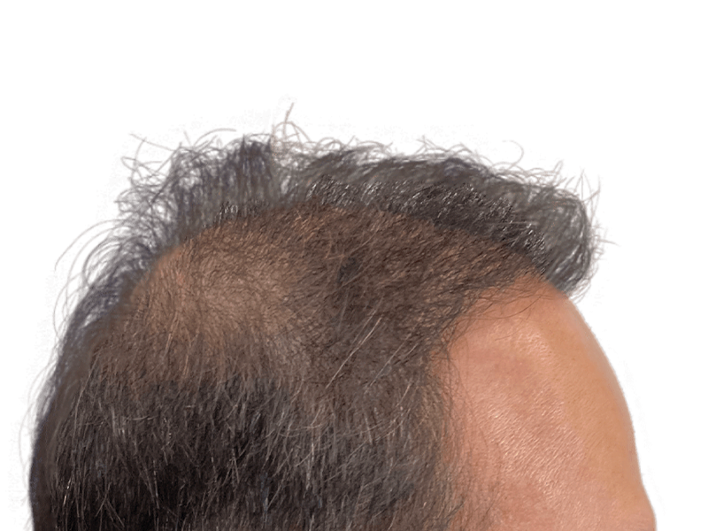 Thinning hair at the front of the head. Potential candidate for hair restoration or hair transplant procedures.