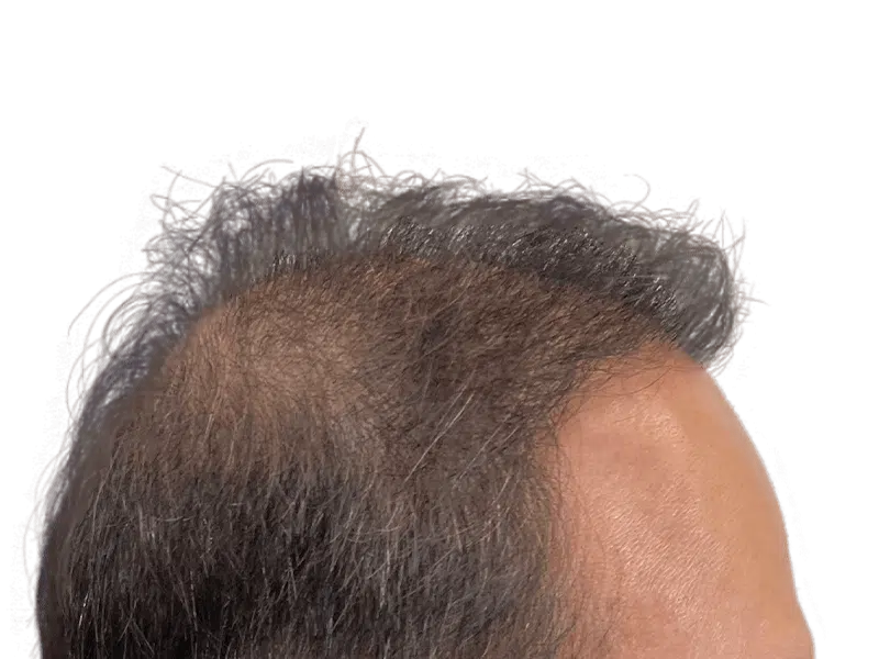 Thinning hair at the front of the head. Potential candidate for hair restoration or hair transplant procedures.