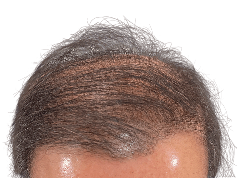 Receding hairline. Thinning gray & brown hair. Possible hair transplant candidate. Before/after results unclear.