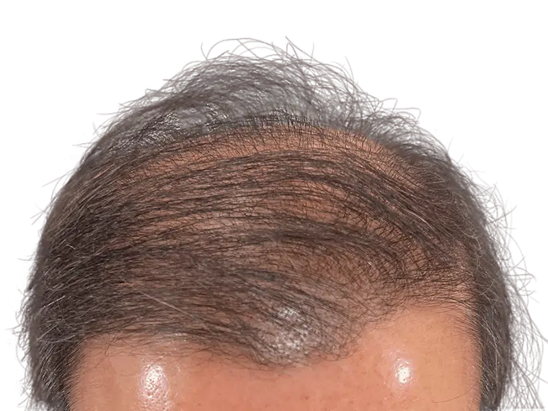 Receding hairline. Thinning gray & brown hair. Possible hair transplant candidate. Before/after results unclear.